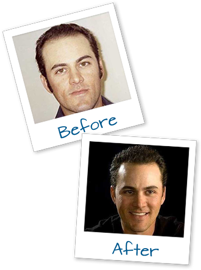before-after Hair Restoration Before After