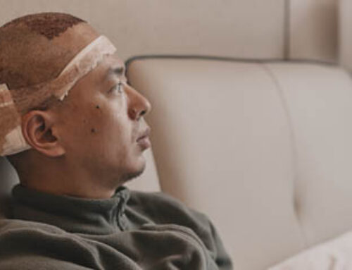 Hair Transplants For Asian Men