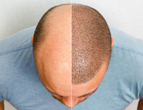 Hair Transplants For Caucasian Men