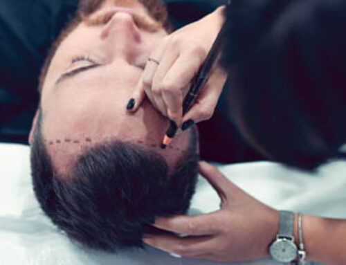 Hair Transplants For Hispanic Men